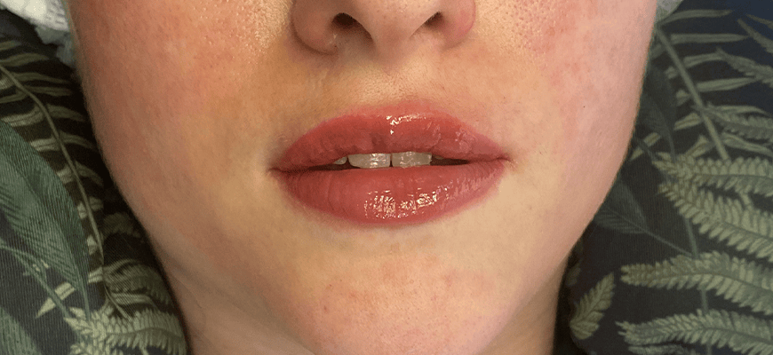 full lips