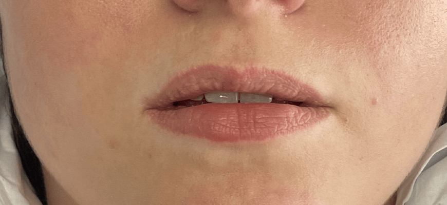 full lips